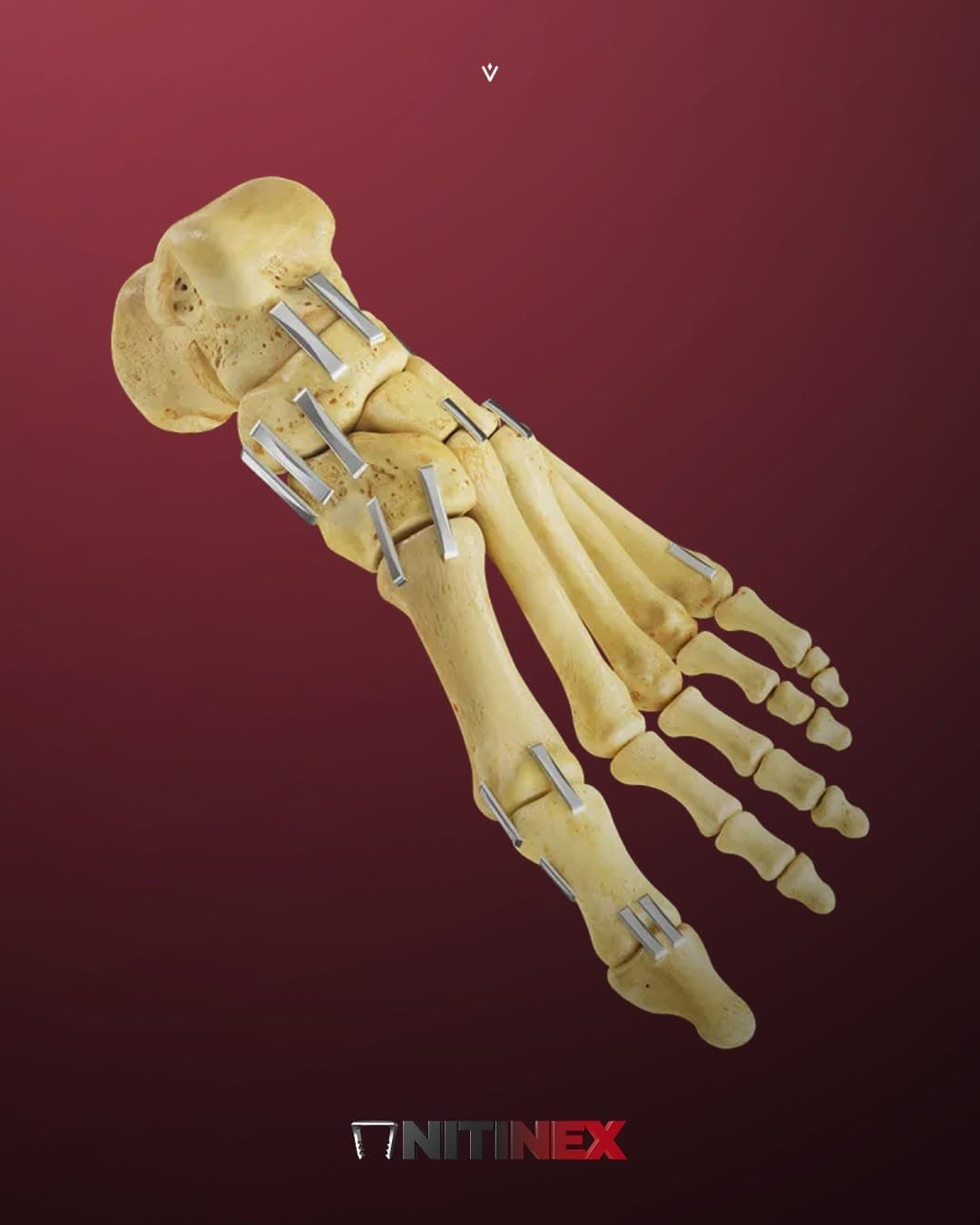 Vilex Nitinex graphic showing implants on a foot skeleton against deep red.